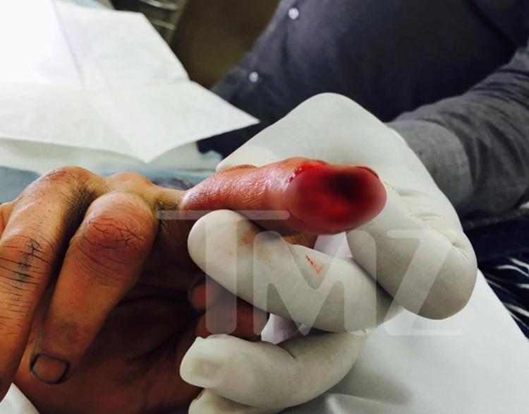 La foto que Johnny Depp filtró a los medios de cómo quedó su dedo tras una pelea con su ex (TMZ) 
